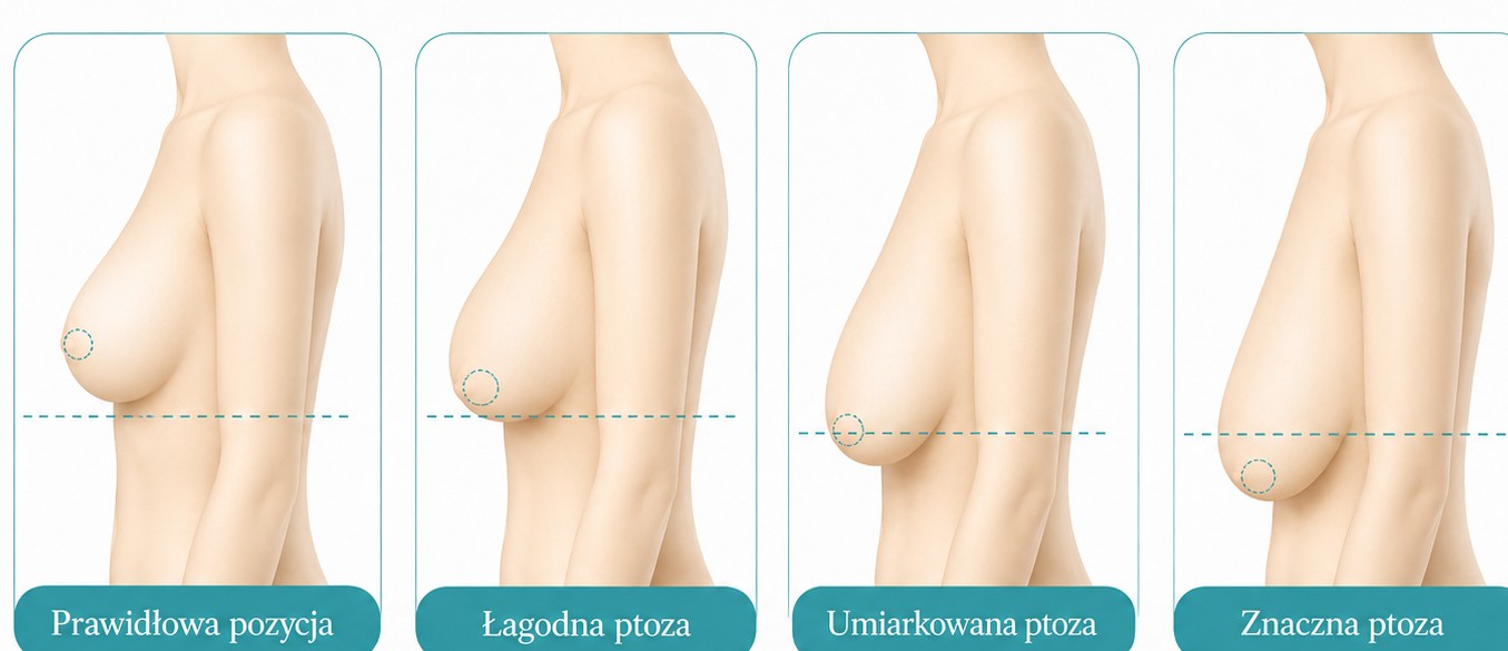 Stopnie opadania piersi